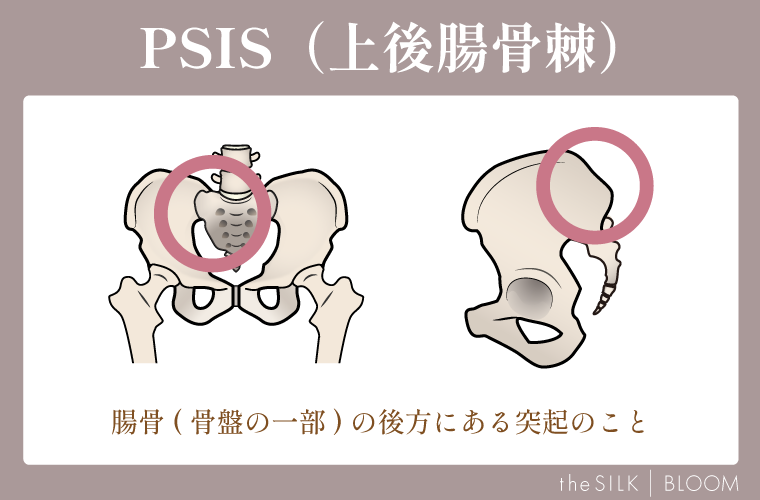 PSIS(上後腸骨棘)の画像